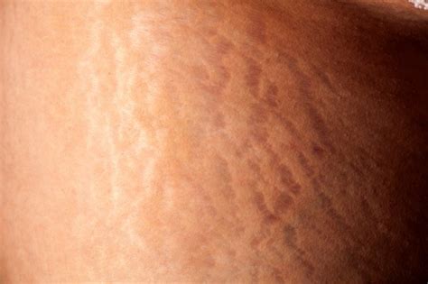 Pregnancy Stretch Marks: Causes, Prevention & Care - Akusi Organics