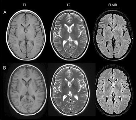 Teaching NeuroImages: MRI abnormalities in frontal lobe seizures due to nonketotic hyperglycemia ...