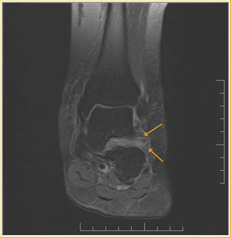 Sinus Tarsi Syndrome : MRI - Sumer's Radiology Blog