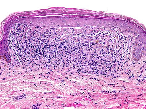 Lichen Striatus Histology