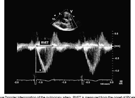 Figure 2 from Pulmonary artery acceleration time provides an accurate ...