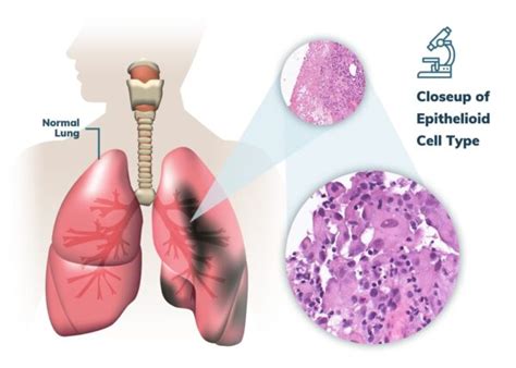 Pleural Mesothelioma | Treatment, Prognosis & Survival