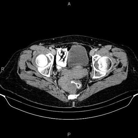 Hemangiopericytoma | Radiology Reference Article | Radiopaedia.org