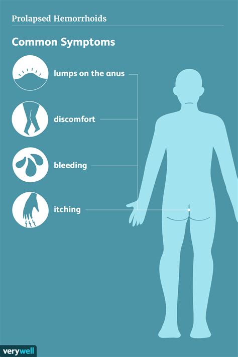 Prolapsed Hemorrhoids: How to Identify and Treat