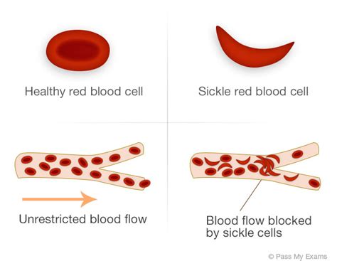 Inherited Diseases: Sickle Cell Anaemia - Pass My Exams