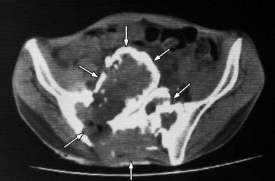 Giant Cell Tumor | Radiology Key