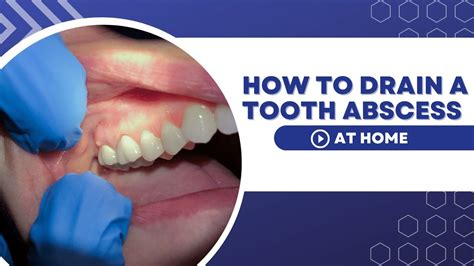 Tooth Abscess Drain