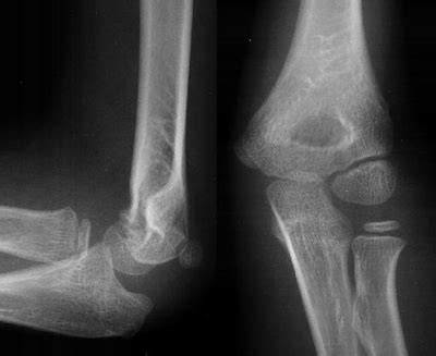 Elbow Joint X Ray