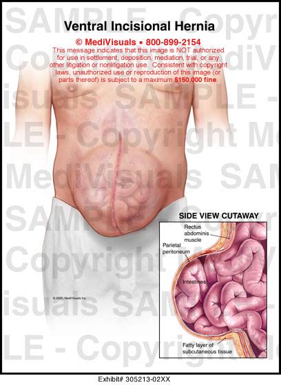 Ventral Incisional Hernia Medical Illustration Medivisuals