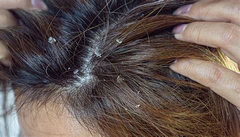 What Is Seborrhoeic Dermatitis? | Fulham Scalp And Hair Clinic