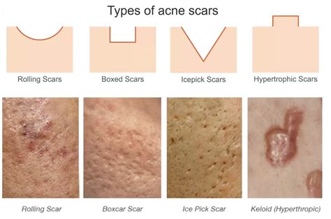 Acne Scars: Types of Acne Scarring and Ideal Treatments