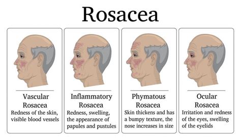 Dealing With Rosacea - Charleston Dermatology