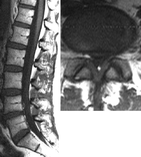 Ligamentum Flavum Hypertrophy Mri