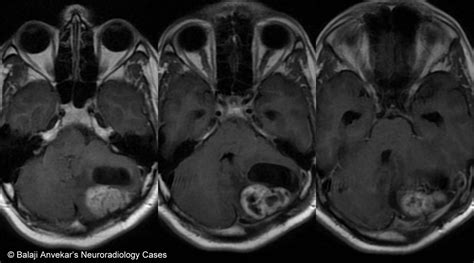 Dr Balaji Anvekar FRCR: Hemangioblastoma MRI