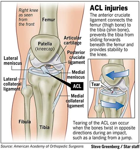 ACL Injuries, Football, and Me - Field Gulls