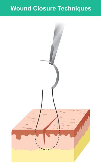 Wound Closure Techniques Isolate Illustration Infographic Stock Illustration - Download Image ...