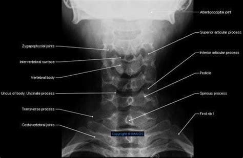 Cervical vertebrae [C I-C VII] - - Radiography : Zygapophysial joints, Uncus of body; Uncinate ...