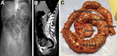 Proximal Megacolon in an Adult - Clinical Gastroenterology and Hepatology