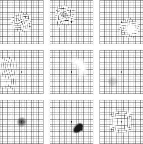 Grid Chart For Macular Degeneration - Printable Worksheets