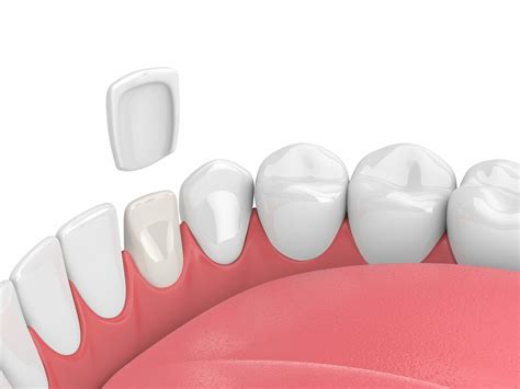 Are Dental Veneers Right for You? - Westerville Dental Associates