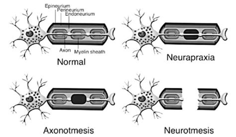 Neurapraxia = nerve contusion Axonotmesis = crushed nerve Neurotmesis ...