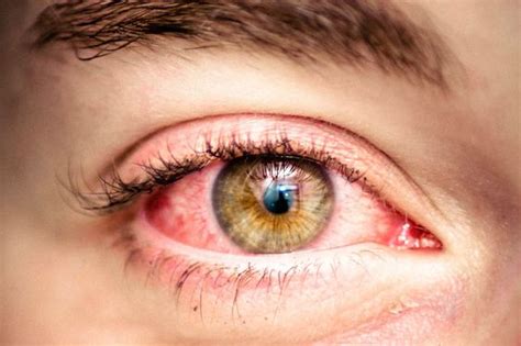 Red Eyes After Smoking Weed?! | Blog | Green Parrot