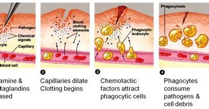 What is inflammation and the steps in the process of inflammation? ~ Biology Exams 4 U