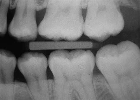 ARE DENTAL X-RAYS NECESSARY? 8 REASONS WHY THEY'RE IMPORTANT