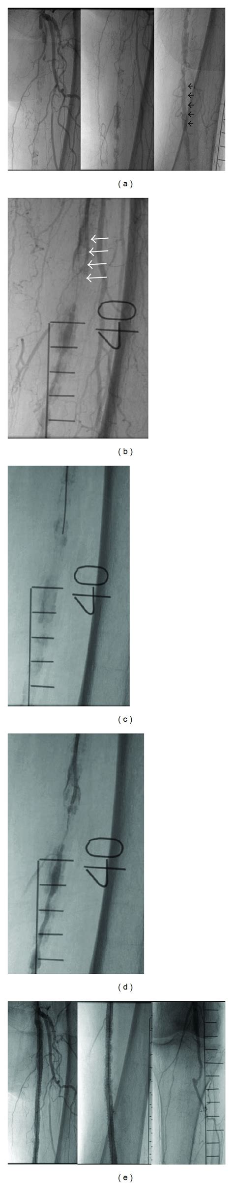 (a) Total occlusion of the superficial femoral artery (SFA) from the... | Download Scientific ...