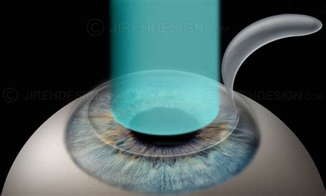 Lasik for nearsightedness - #SURLM0003 - Stock eye images