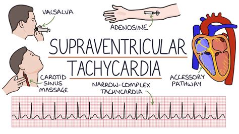 Paroxysmal Atrial Tachycardia Vs Sinus Tachycardia