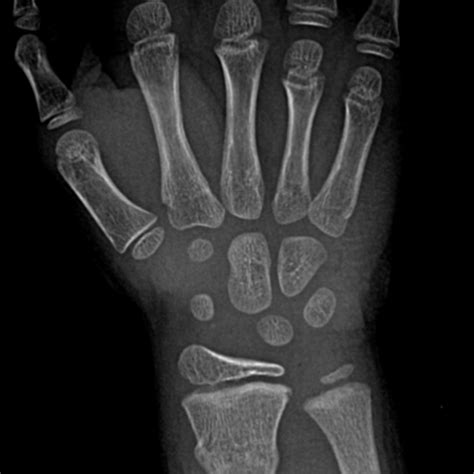 CaseStacks.com - Interactive Pediatric Wrist & Hand Radiograph Cases