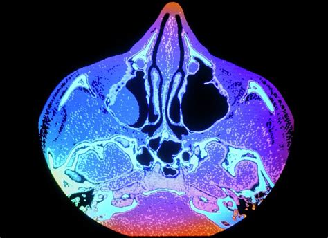 Coloured Ct Scan Showing A Large Polyp In A Sinus Photograph by Gjlp/science Photo Library