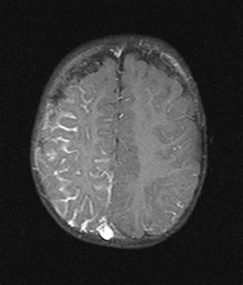 Compva: Sturge-Weber syndrome