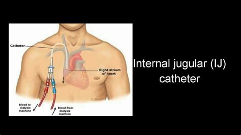 Bye, bye IJ catheter :) - YouTube