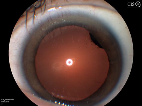 Iris Melanoma - Retina Image Bank