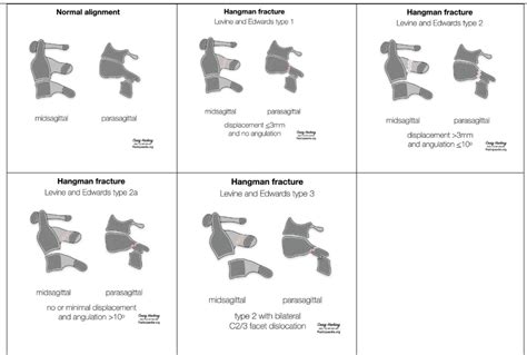 Surgical Management of Hangman’s Fracture: A Systematic Review ...