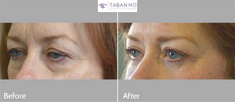 Eyelid Ptosis Before and After Gallery | Taban MD