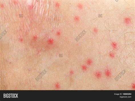 Mosquito Allergy On Image & Photo (Free Trial) | Bigstock