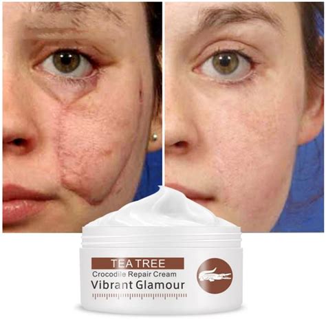 Scar Repair Face Cream Acne Removal Whitening Acne Treatment Stretch Marks Skin Care Cream new ...