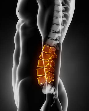 Lumbar Corpectomy and Fusion - Birmingham, AL - Spine and Neurosurgery