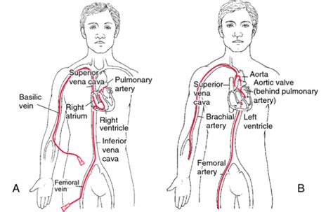 Angiogram (Cardiac Catheterization) - Edmonton Cardiology Consultants