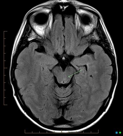 Internuclear Ophthalmoplegia Mri