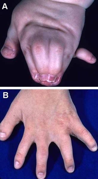 Pfeiffer syndrome: MedlinePlus Genetics