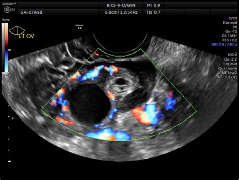 Ectopic Pregnancy Ultrasound 8 Weeks