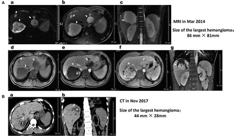 Cavernous Hemangioma Liver Ultrasound