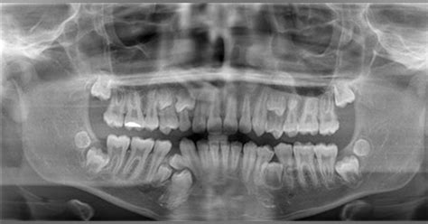 Supernumerary Teeth | Registered Dental Hygienists