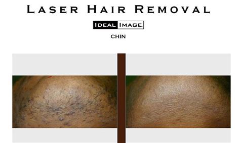 I Want The Laser Hair Removal From Ideal Image - Verastic