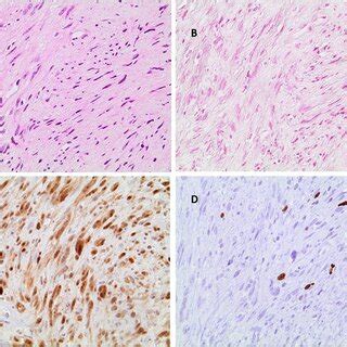 Histology of the intracerebral schwannoma. The tumor is mainly composed ...