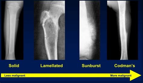 periosteal reactions: solid, lamellated, sunburts, codman's | Radiology ...